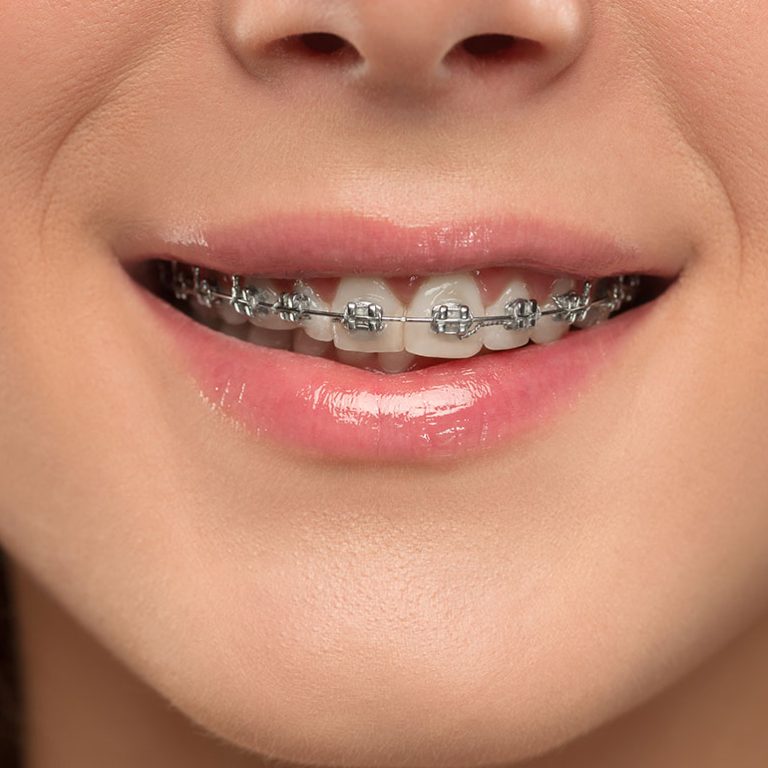 brackets